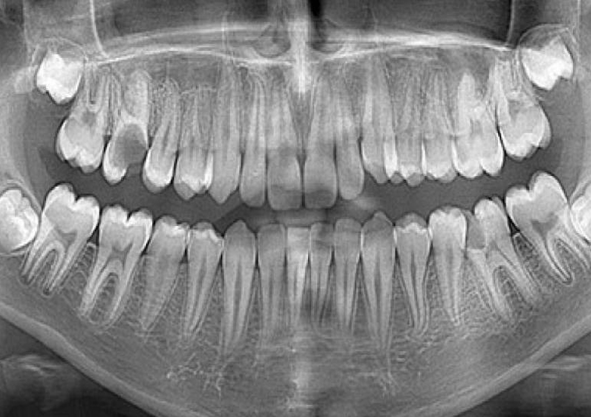 Dental Tomografi